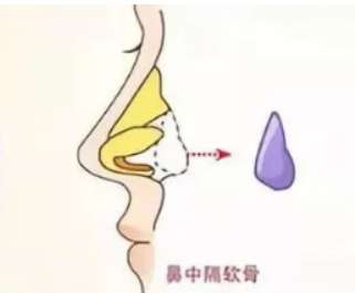 隆鼻
