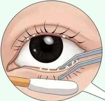 下睑手术动漫02.jpg 下睑手术动漫02.jpg