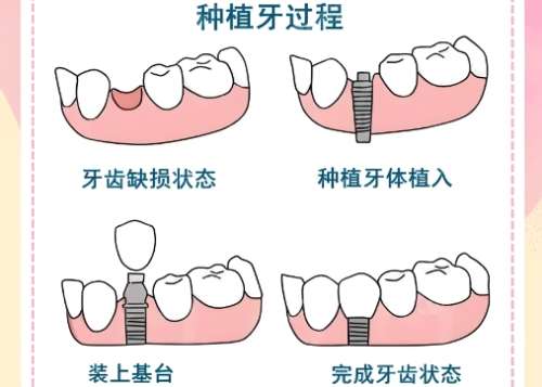 牙齿种植