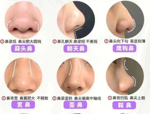 鼻修复