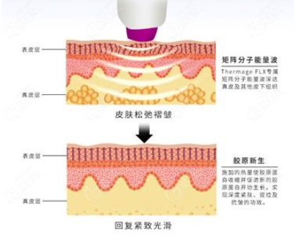 热玛吉2.png