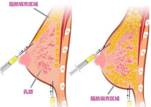 脂肪填充