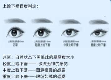 双眼皮