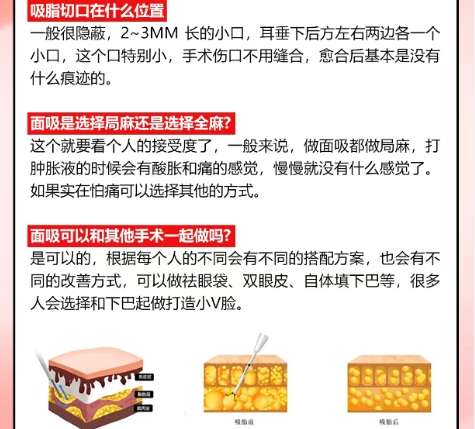 面吸 面吸