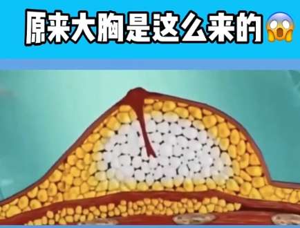 隆胸