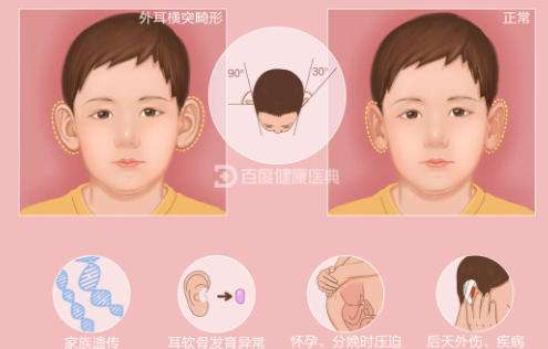 招风耳3.jpg