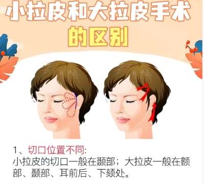 拉皮 拉皮