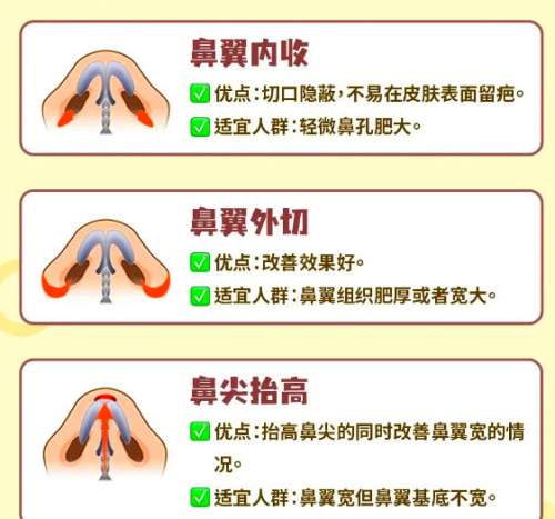 鼻翼缩小
