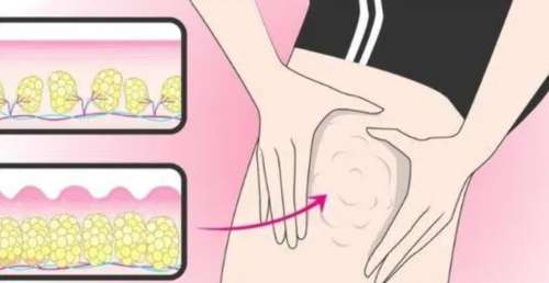 小腿吸脂dm03.jpg