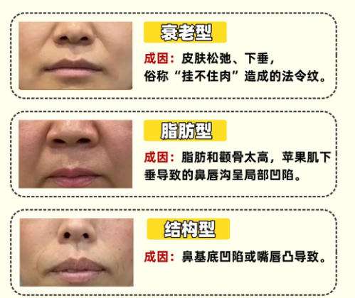 法令纹.jpg