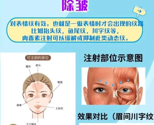 除皱