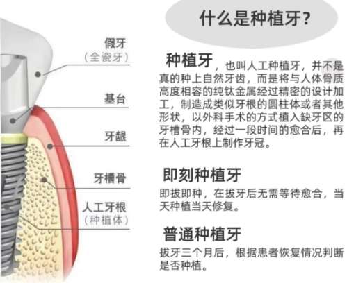 牙齿种植
