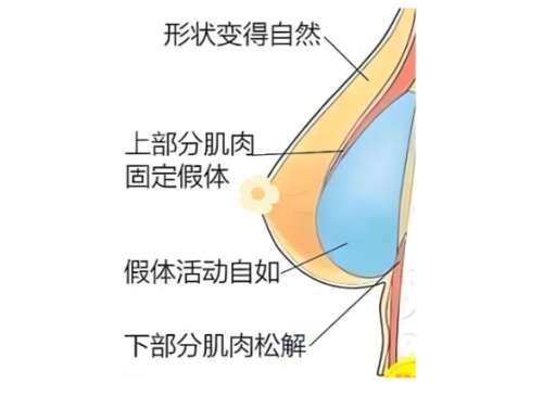 隆胸