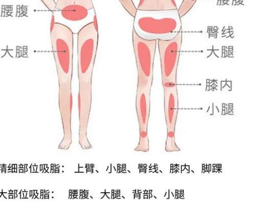 吸脂 吸脂
