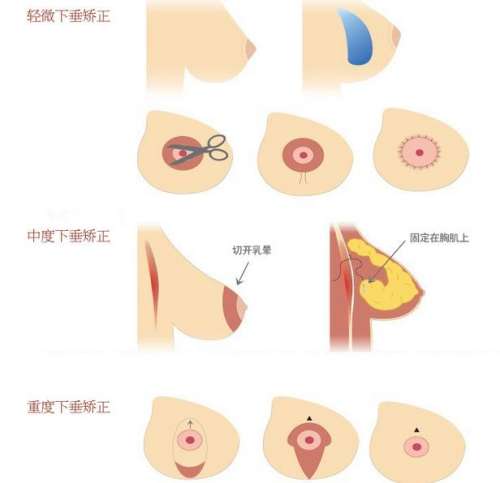 乳房悬吊术2.jpg