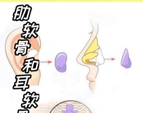 肋骨鼻1.jpg