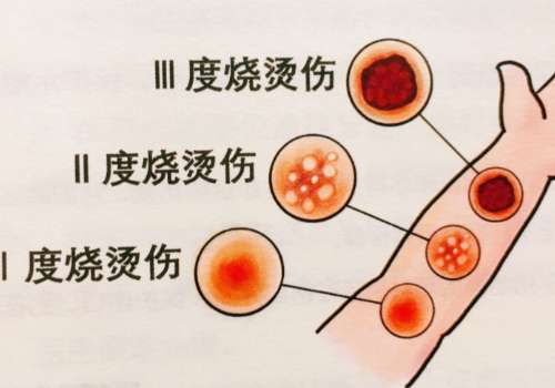 烧伤整形修复.jpg