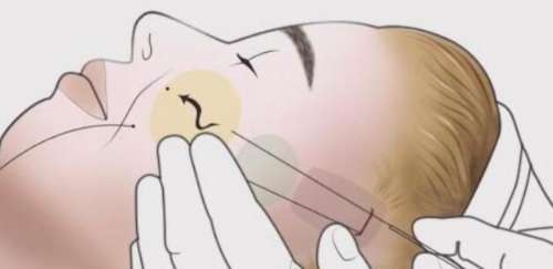 除皱