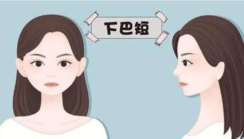 下巴后缩