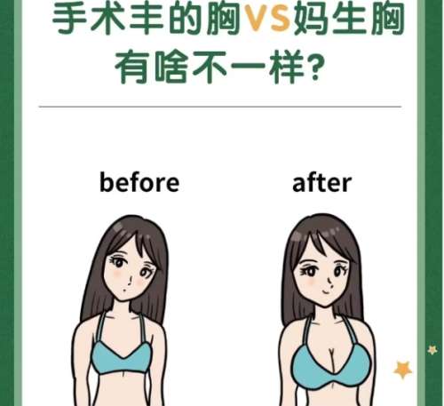 隆胸