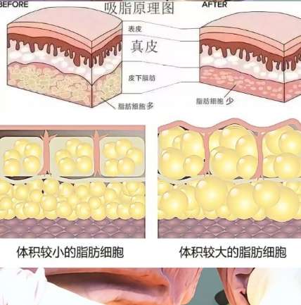 吸脂