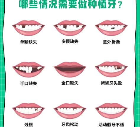 牙齿种植 牙齿种植