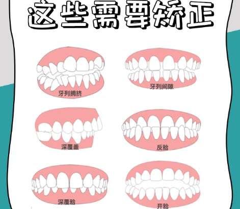 牙齿矫正 牙齿矫正