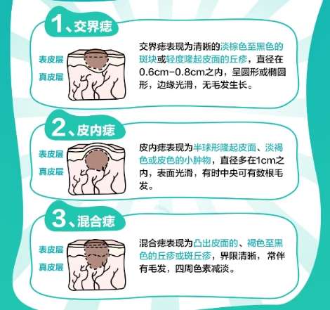 祛痣 祛痣