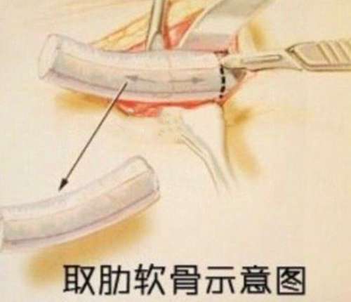 隆鼻