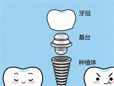 种植满口牙需多少钱?价格范围公布!