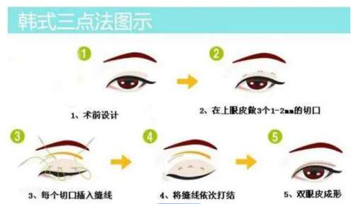 双眼皮