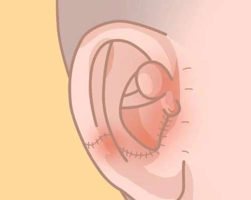 耳再造