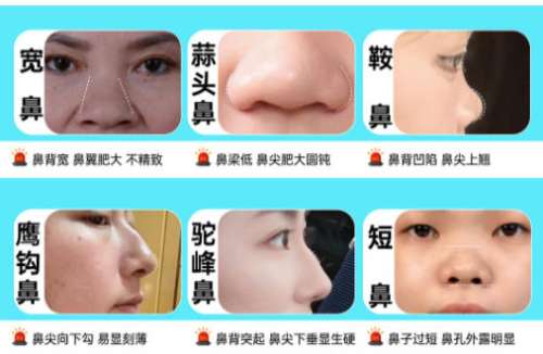 隆鼻14.jpg 隆鼻14.jpg