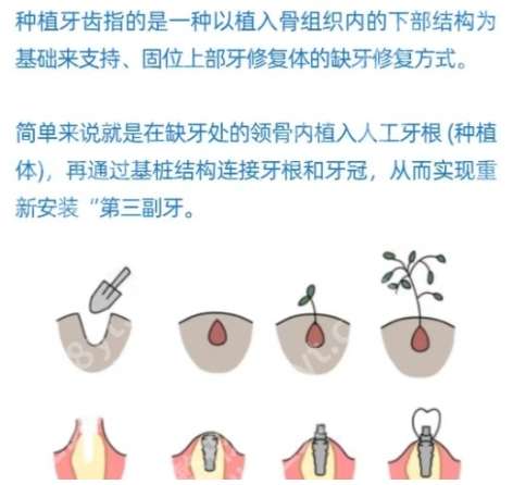 种植牙