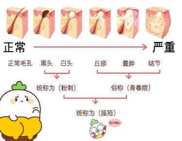 祛痘