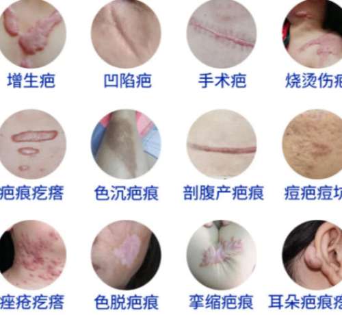 瘢痕挛缩dm.jpg