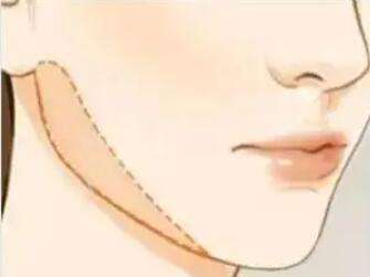 下颌角 下颌角
