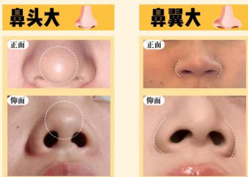 隆鼻