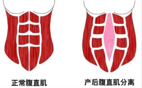 腹壁整形4.png