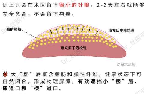 脂肪隆胸1.jpg