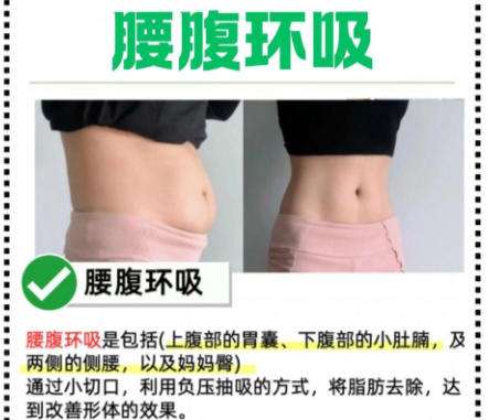 腰腹吸脂