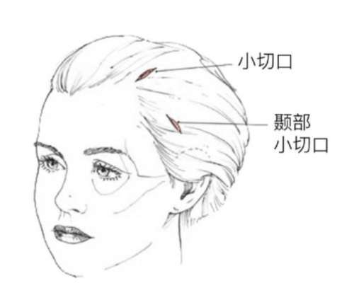 拉皮
