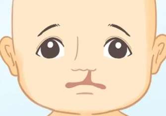 唇腭裂鼻孔一大一小h01.jpg