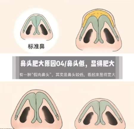 鼻翼缩小