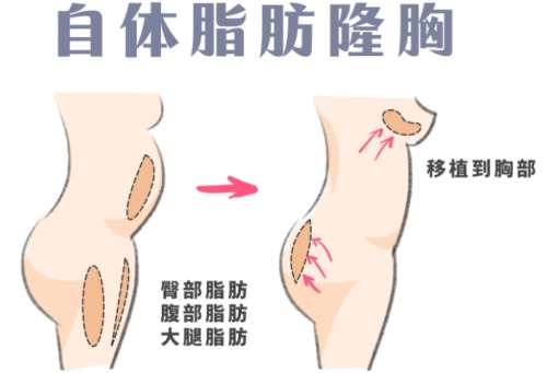 自体脂肪