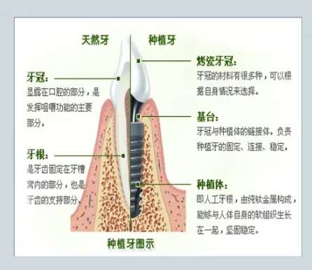 牙齿种植