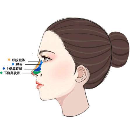 隆鼻