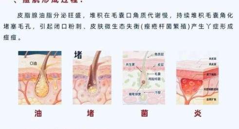 祛痘3.jpg