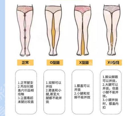 北京知音整形o型腿怎么样?这些优势项目您可知道?想了解的千万别错过!