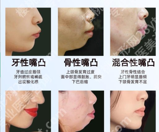 哈尔滨牙齿矫正手术多少钱？价格在8k到4w不等有可靠医院推荐！
